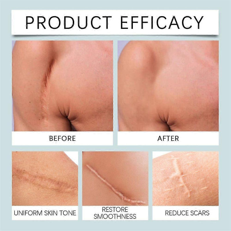 ✨ LANISKA Silicone Scar Tape ✨ ( BUY 1 GET 1 FREE )