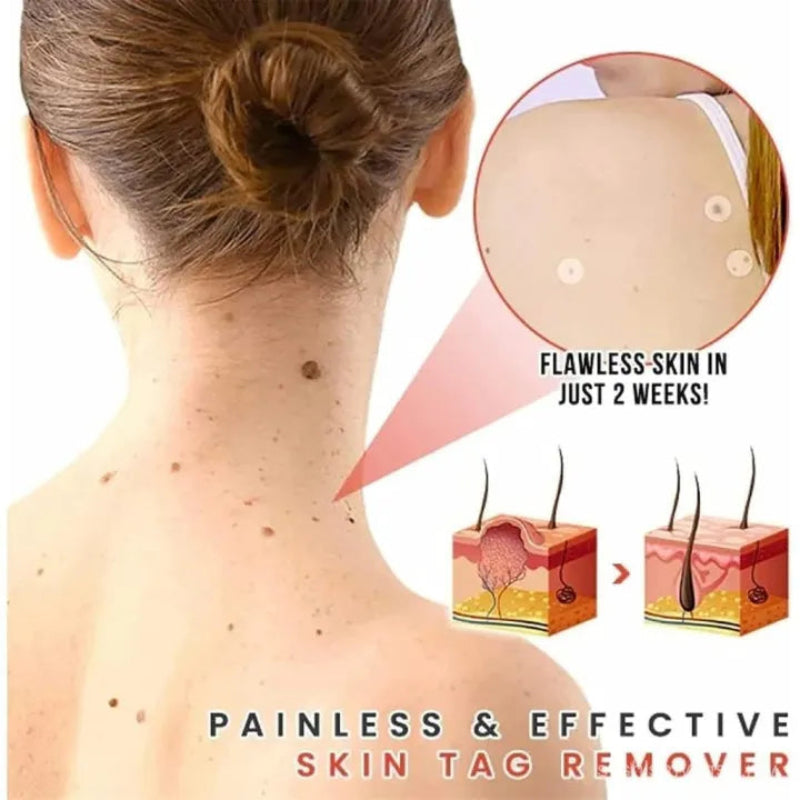 🌿✨ MICRONEEDLE BOTANIC SKIN TAG SOLUTION PATCH ✨🌿 ( BUY 1 GET 1 FREE )