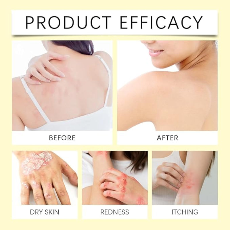 ✨ South Moon Bee Venom Psoriasis Care Patch ✨ ( BUY 1 GET 1 FREE )