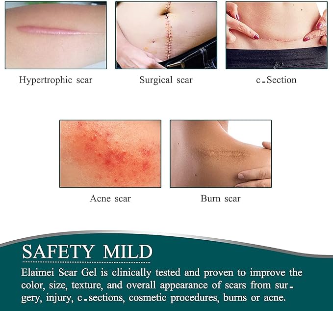 Laniska Silicone Scar Sheets ( BUY 1 GET 1 FREE )