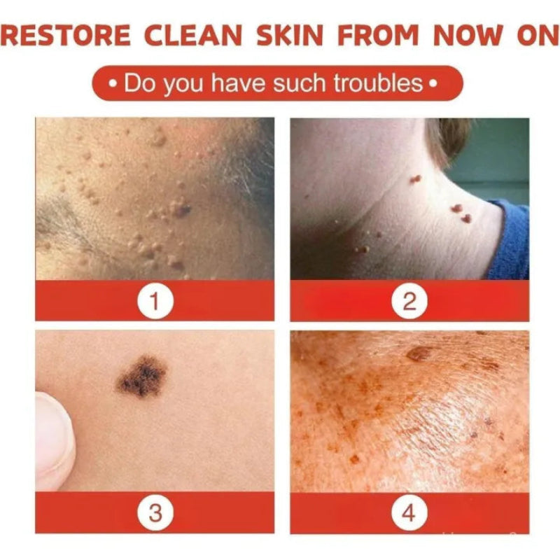 🌿✨ MICRONEEDLE BOTANIC SKIN TAG SOLUTION PATCH ✨🌿 ( BUY 1 GET 1 FREE )