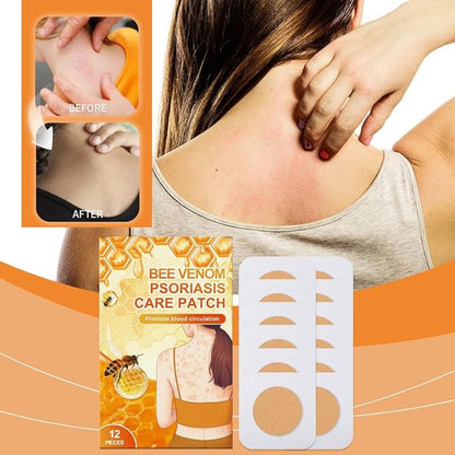 ✨ South Moon Bee Venom Psoriasis Care Patch ✨ ( BUY 1 GET 1 FREE )
