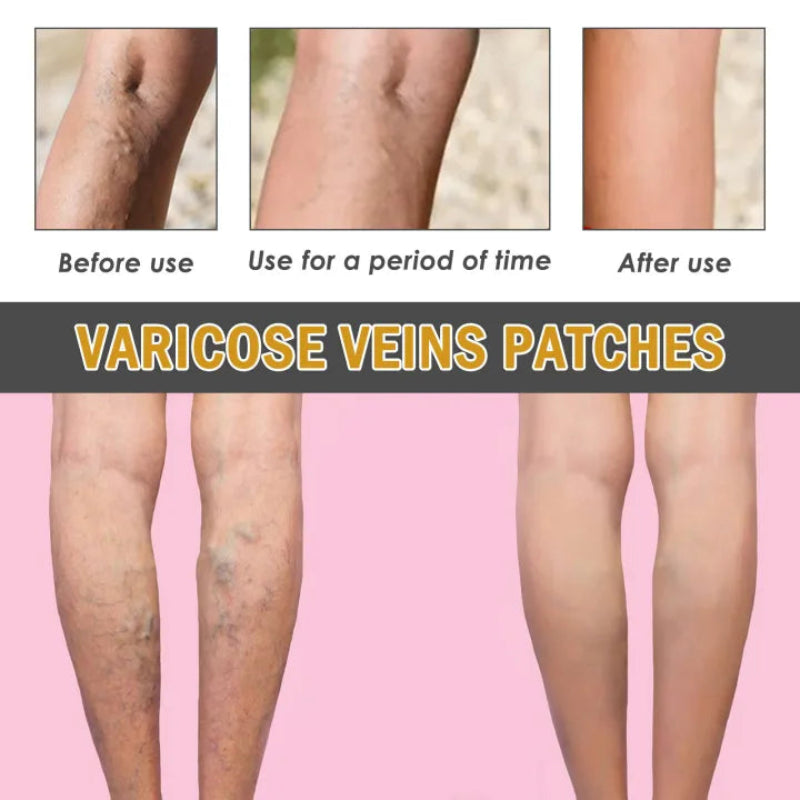 ✨ South Moon Varicose Veins Relief Patches ✨ ( BUY 1 GET 1 FREE )