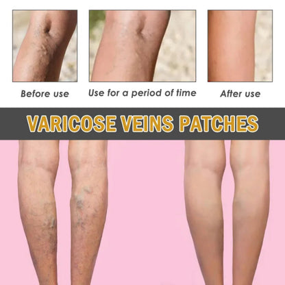 ✨ South Moon Varicose Veins Relief Patches ✨ ( BUY 1 GET 1 FREE )