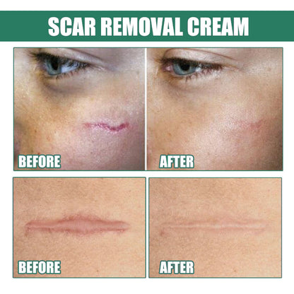 ✨ EELHOE Scar Remove Cream ✨ ( BUY 1 GET 1 FREE )