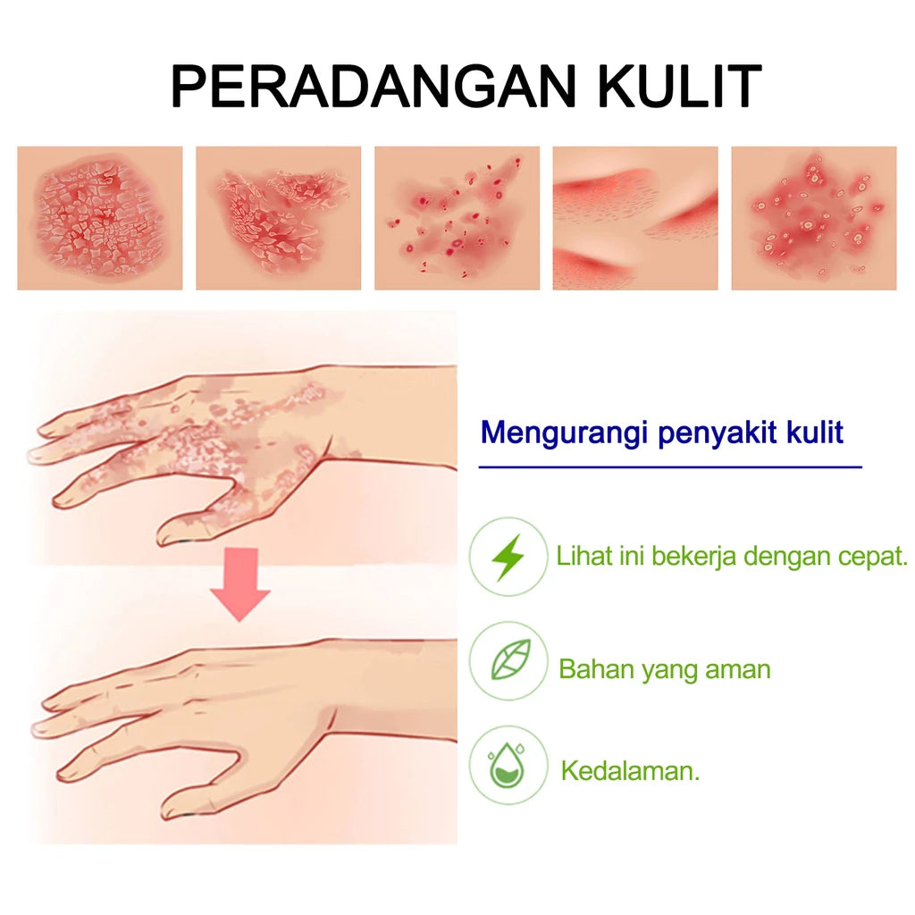 Sumifun Anti - psoriasis Cream (BUY 1 GET 1 FREE)