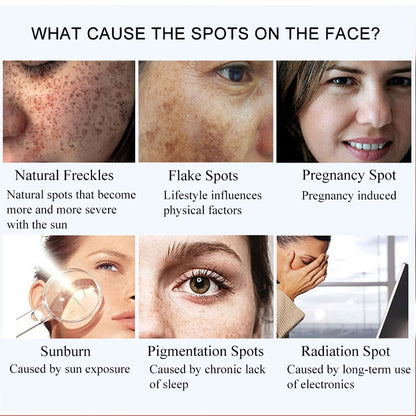 377 Whitening Dark Spots Cream ( BUY 1 GET 1 FREE )