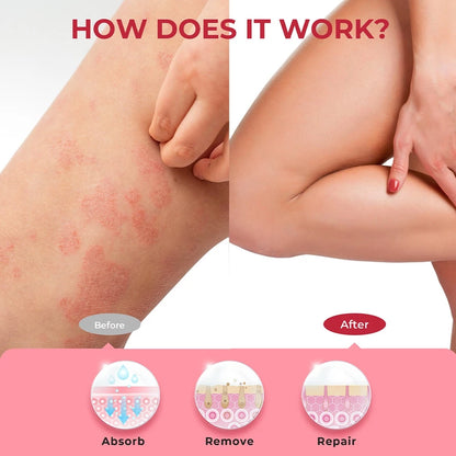 Sumifun Anti - psoriasis Cream (BUY 1 GET 1 FREE)