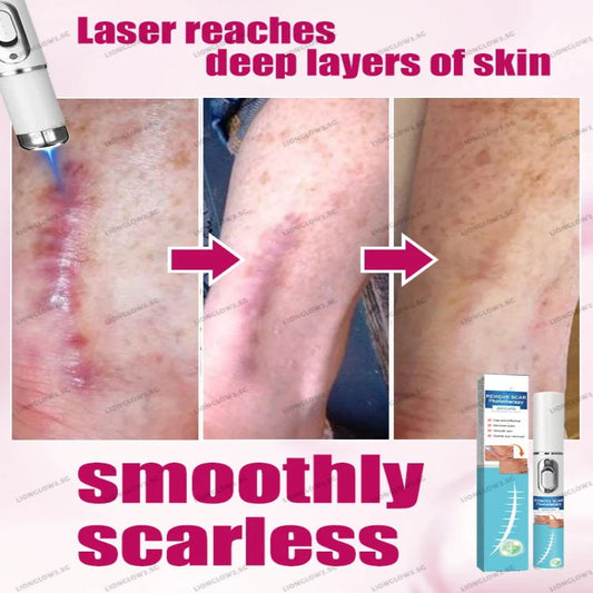 ✨ Laser Scar Removal Pen ✨ ( BUY 1 GET 1 FREE )