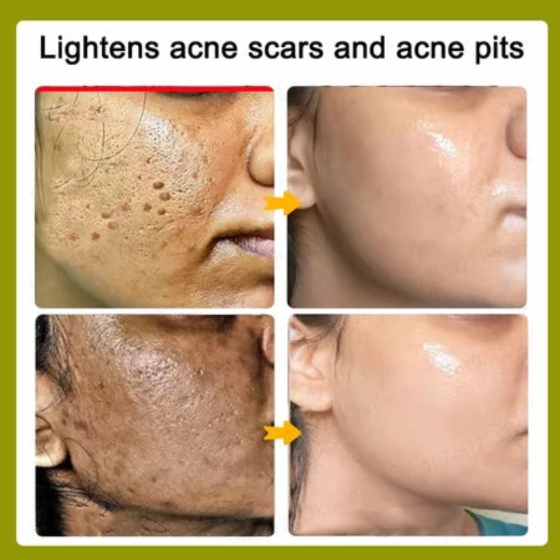 Lydmoon Scar Removal Cream ( BUY 1 GET 1 FREE )