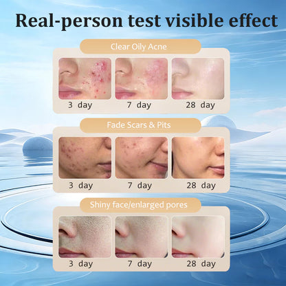 🌿✨ Herbal Acne Scar Removal Cream ✨🌿 ( BUY 1 GET 1 FREE )