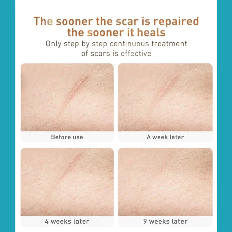 Medical Silicone🔥 scar patch ( BUY 1 GET 1 FREE )