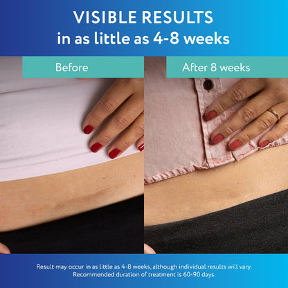 ✨ ScarAway Medical-Grade Silicone Clear Scar Sheet ✨ ( BUY 1 GET 1 FREE )
