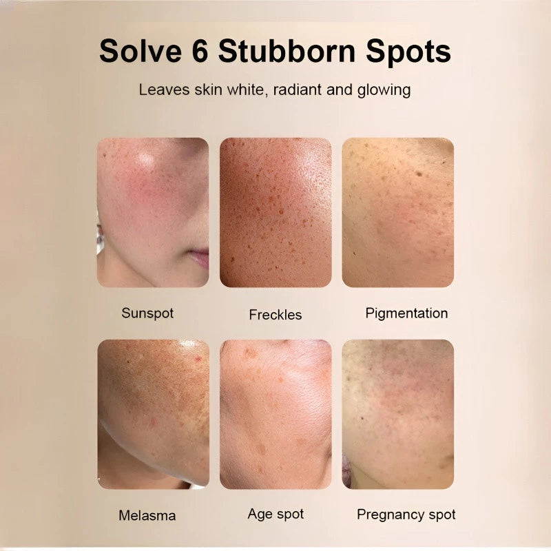 Herbal Whitening Freckle Cream ( Buy 1 Get 1 Free )