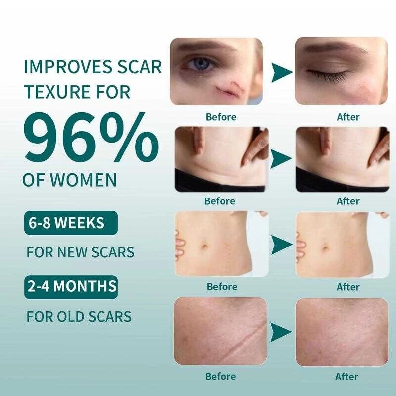 ✨🩹 Qustere Silicone Scar Sheet 🩹✨ ( BUY 1 GET 1 FREE )