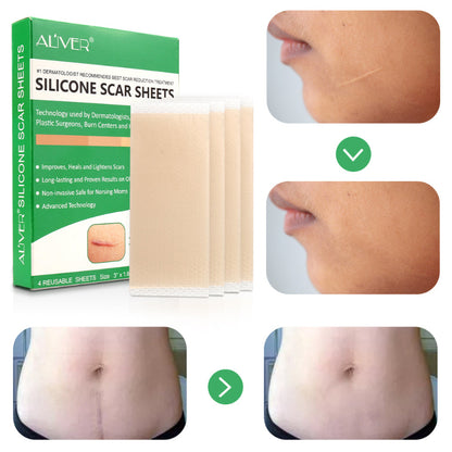 ✨ ALIVER Silicone Scar Sheet ✨ ( BUY 1 GET 1 FREE )