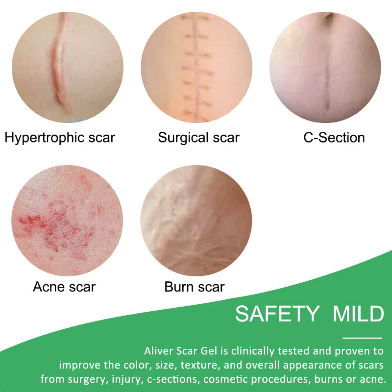 ✨ ALIVER Silicone Scar Sheet ✨ ( BUY 1 GET 1 FREE )