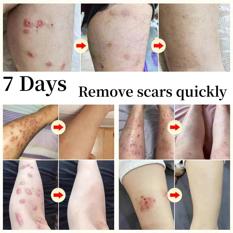 LANEMAY SCAR DISAPPEARS CREAM ( BUY 1 GET 1 FREE )