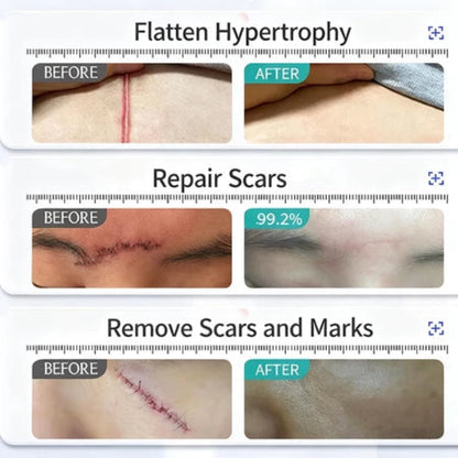 Lydmoon Scar Removal Cream ( BUY 1 GET 1 FREE )