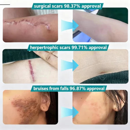 Lydmoon Scar Removal Cream ( BUY 1 GET 1 FREE )